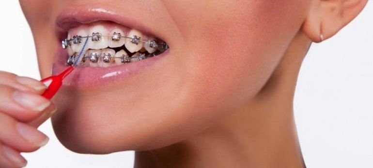 apiñamiento dental