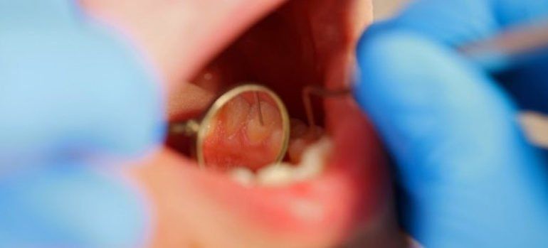beneficios limpieza bucal