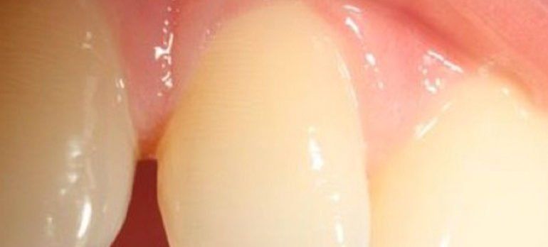 Diastema