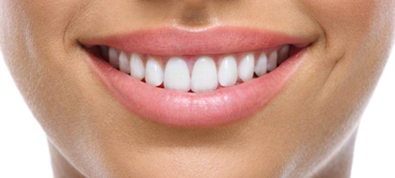 blanqueamiento dental