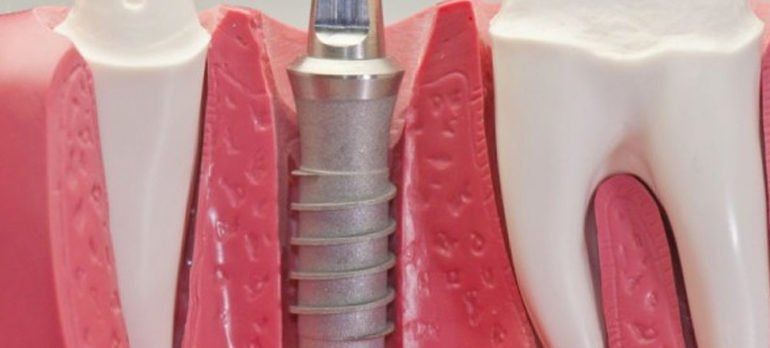 implantes dentales