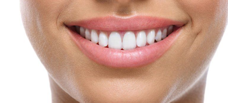 Carillas dentales