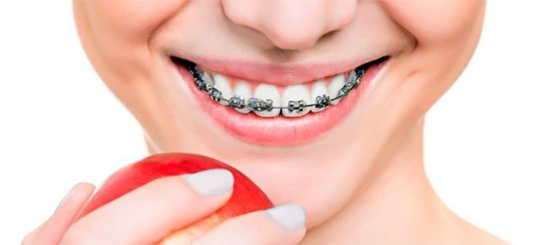 ¿Qué tipo de Ortodoncia necesito: preventiva, interceptiva o correctiva?
